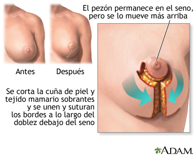 aumento de mamas barcelona
