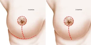 reducción de mamas Barcelona